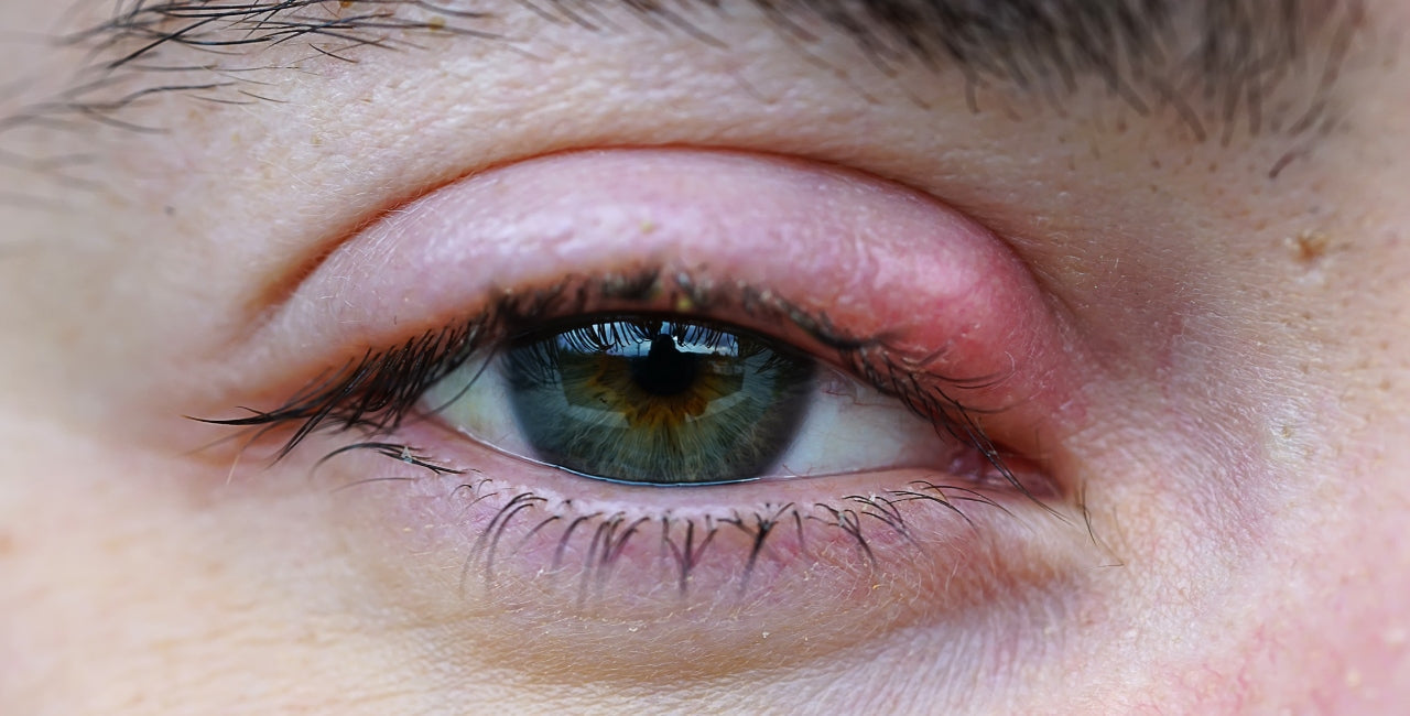 Best Tools for Managing a Chalazion and Styes at Home
