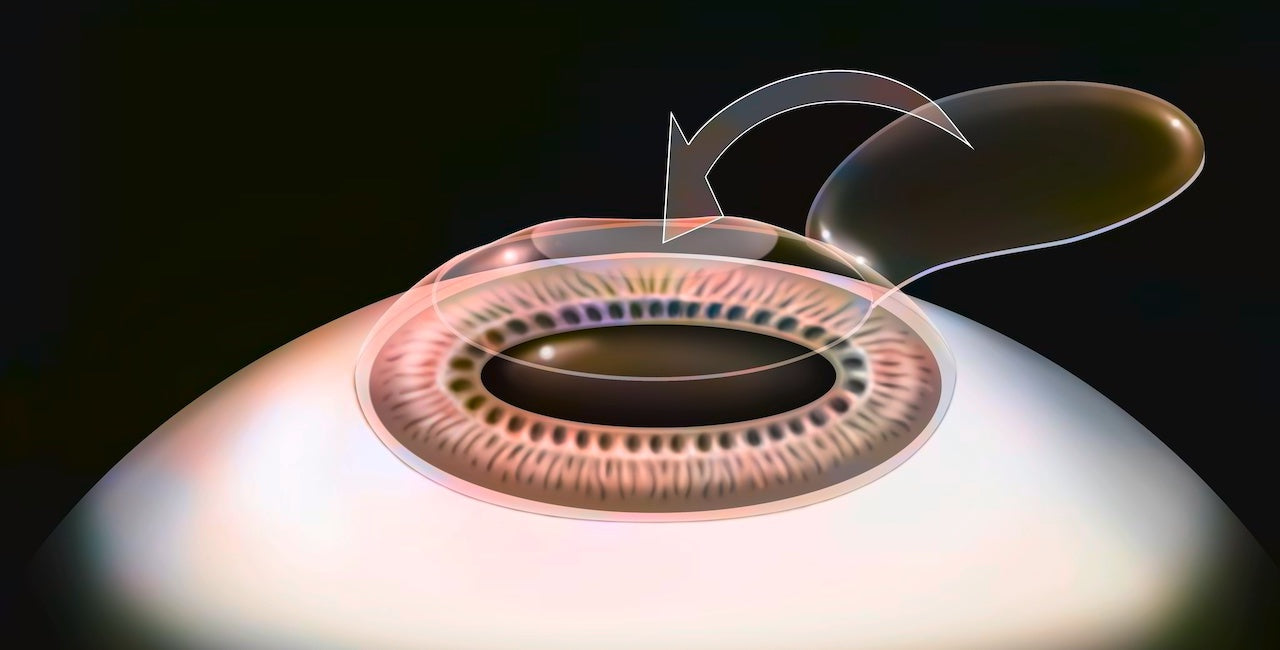 LASIK Eye Surgery Side Effects: Dry Eye